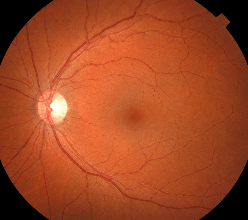 AI rendering of a healthy retina (fundus photo)
